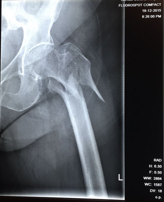 Left Hip fracture.jpg