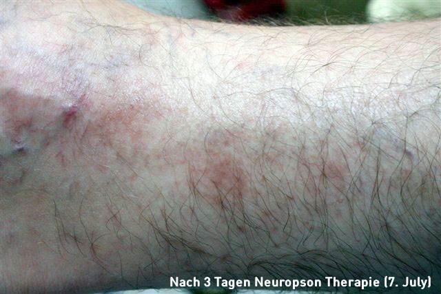 Hans-Brenner-Neuropson-Therapie-07Juli-2016-text.jpg