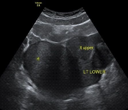 Endoemetirosis.jpg