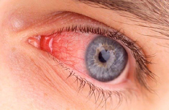 Acaci-_for-Conjunctivitis-in-Hindi.jpg