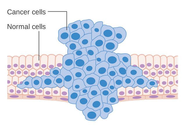 Formation of a tumor forcing its way into the adjacent tissues
