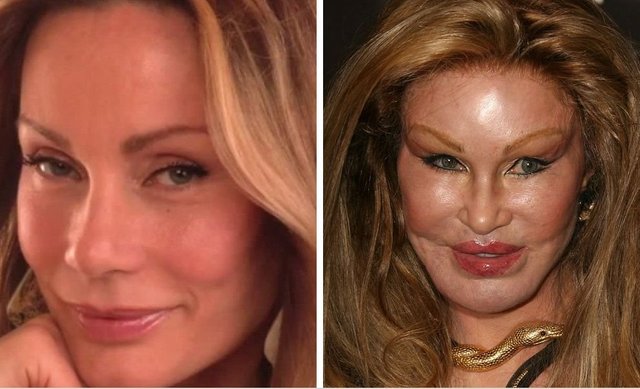 20-worst-cases-of-celebrity-plastic-surgery-gone-wrong-4.jpg