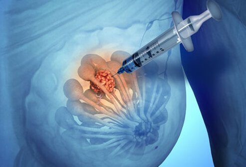 breast-cancer-s8-photo-of-breast-biopsy.jpg