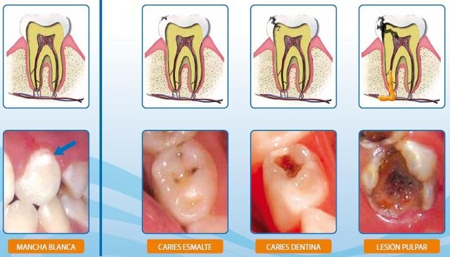 evolucion-caries-dental.jpg