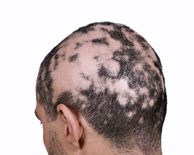 alopecia-areata.jpg