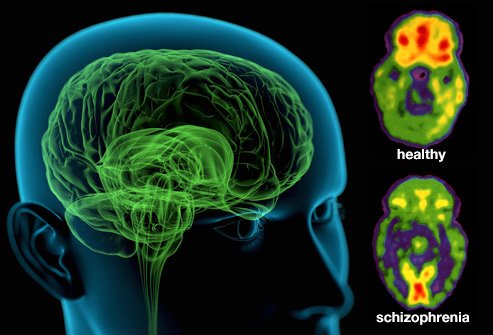 webmd_rm_photo_of_schizophrenic_brain.jpg