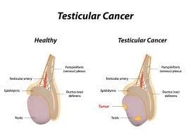 testicular cancer..jpg