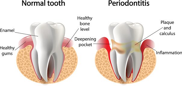 gumdiseaseinfographic.jpg