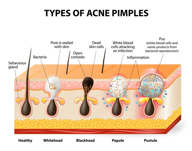 types-of-acne-diagram.jpg