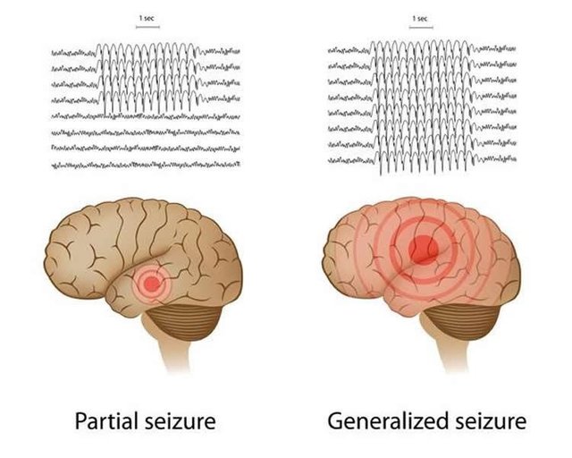 genetics-depression-epilepsy-neurosciencenews.jpg