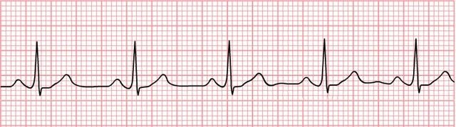 Normal_Sinus_Rhythm_Unlabeled_640x179.jpg