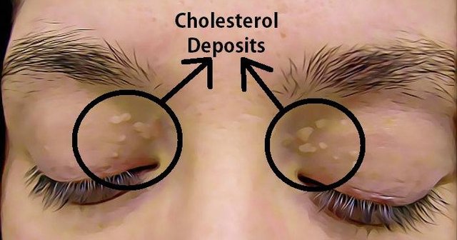 Cholesterol-Deposits.jpg