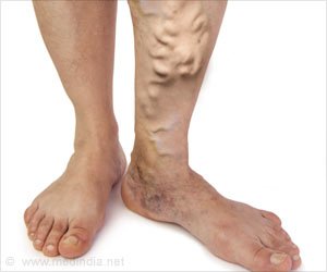 varicose-veins.jpg