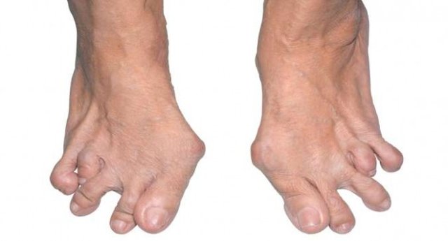 rheumatoid-arthritis-foot-655x353.jpg