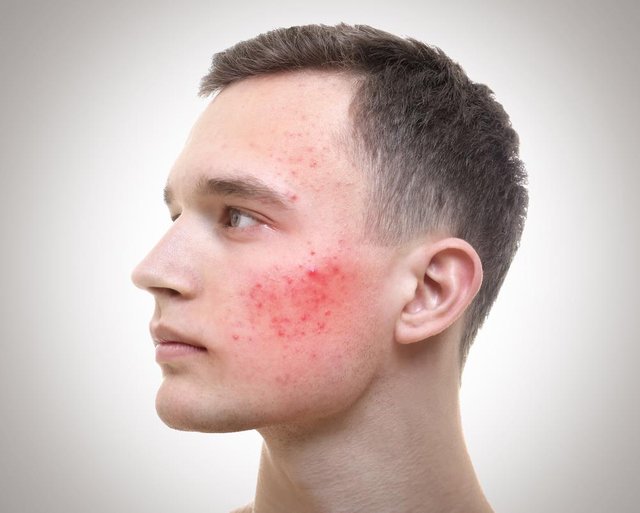 how-to-get-rid-of-redness-from-acne.jpg