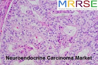 Neuroendocrine Carcinoma Market.jpg