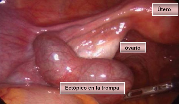 ectopico en la trompa.jpg