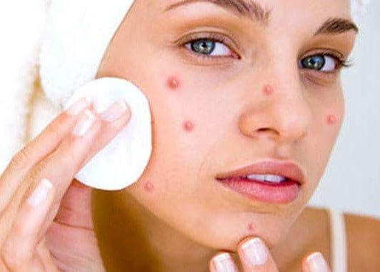 How-to-Get-Rid-of-a-Blind-Pimples-Fast.jpg