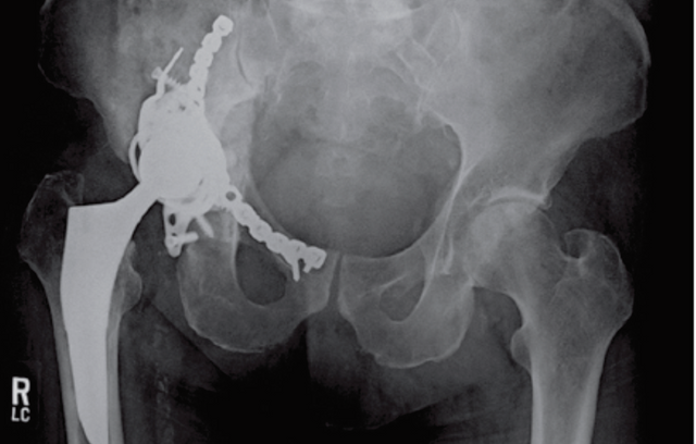 acute-stress-fracture-of-the-pelvis-after-total-hip-arthroplasty-a