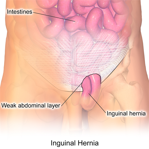 Blausen_0560_InguinalHernia_500x500.jpg