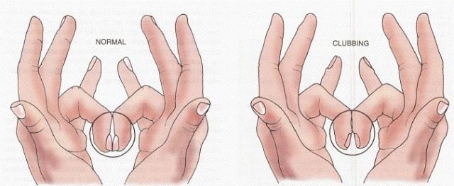 How To Know If You Have A Heart Disease Using Only With Fingers And Nails Steemit