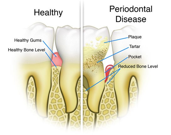 periodontal-disease.jpg