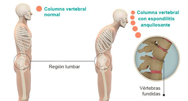 espondilitis_columna1.jpg