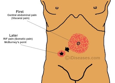 where-is-appendicitis-pain-location-of-appendicitis-pain-appendix-pain-location-symptoms.jpg