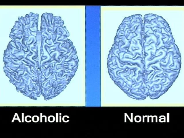 mozek alkoholika.jpg