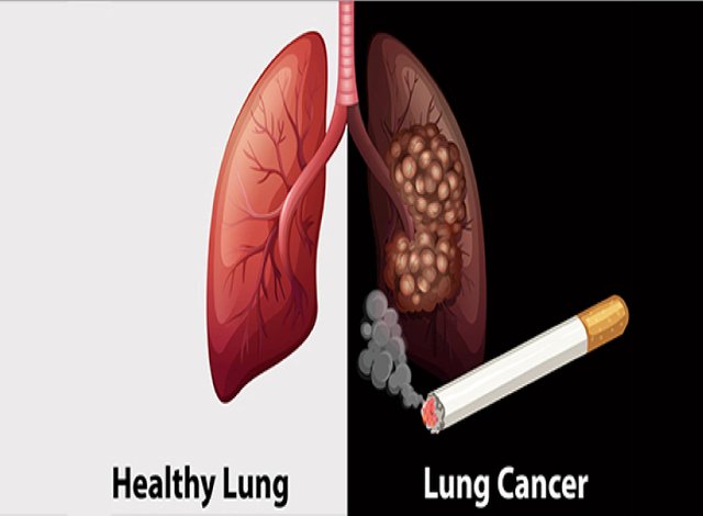 What Are Lung Diseases Caused By Smoking Asthma Lung Disease