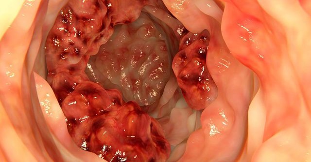 colon-cancer-FI-1-800x419.jpg