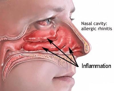 inflamasi-pada-rhinitis-alergi.jpg