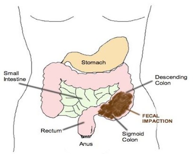 impacted-bowel-impacted-stool-impacted-colon-faecal-impaction.jpg