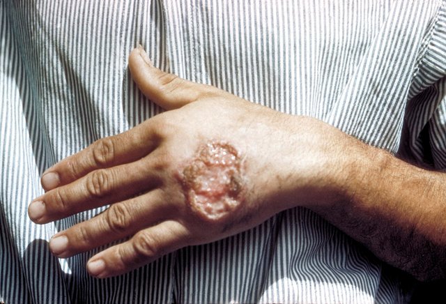 leishmaniasis.jpg