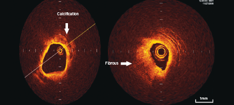 Optical Coherence Tomography.png