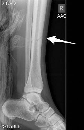 Lat-tibia-ND.jpg