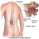 Blausen_0484_HerniatedLumbarDisc (1).png