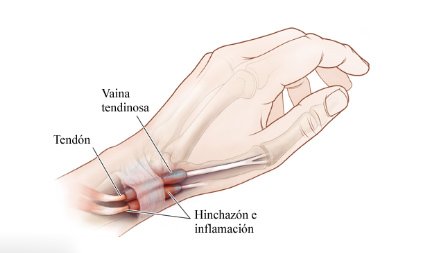 tendinitis-de-quervain.jpg