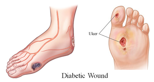 diabetic foot ulcer.png