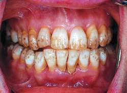 fluorosis.jpg