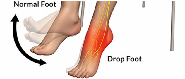 foot drop.png