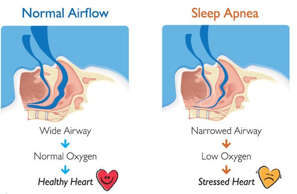 sleep-apnea-diagram.jpg