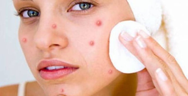 Who-to-Get-Rid-Of-Pimples.jpg