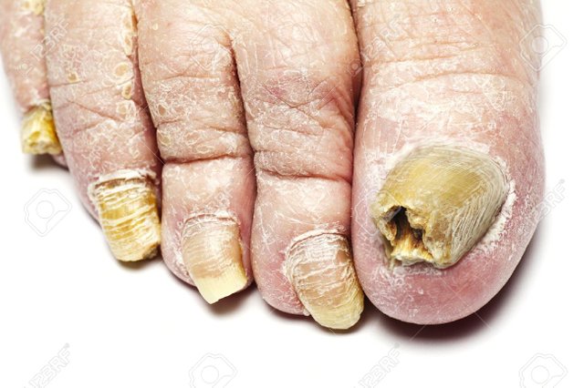 12956046-fungus-infection-on-nails-of-man-Stock-Photo.jpg