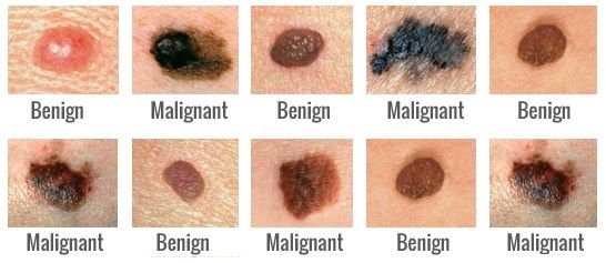 Skin Cancer Chart Pictures