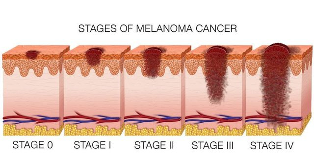 melanoma-skin-cancer-stages.jpg