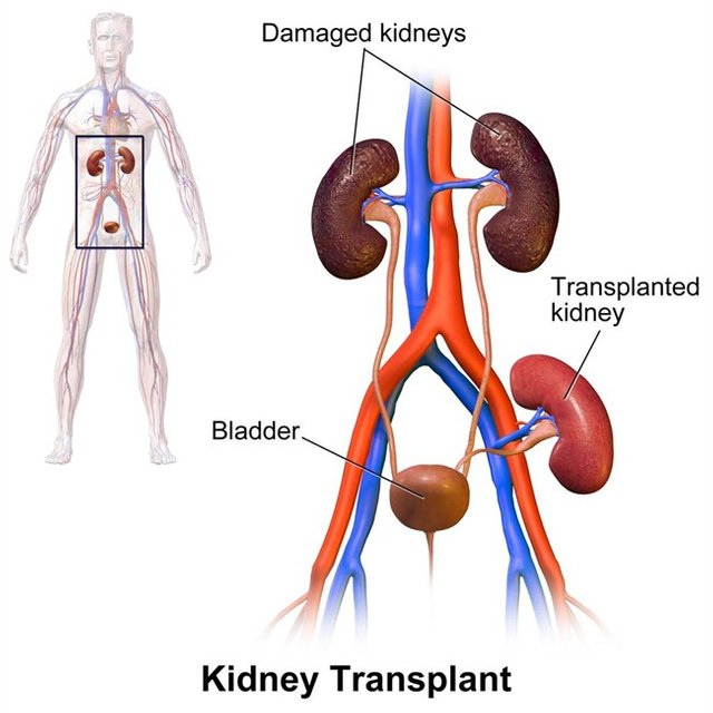 Kidney_Transplant.jpg