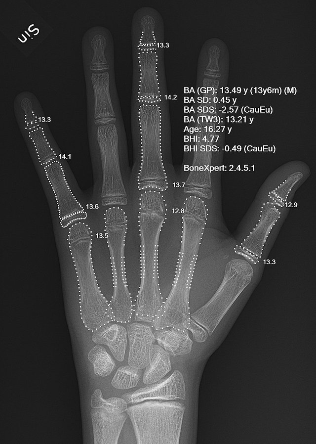 800px-X-ray_of_a_hand_with_automatic_bone_age_calculation.jpg