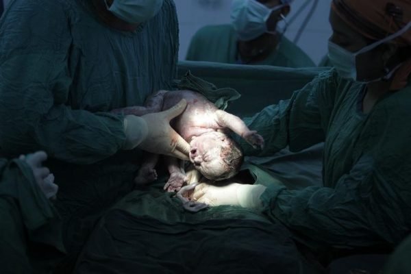 cesarean-600x400.jpg