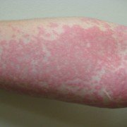 Cholinergic_Urticaria_Destroyed_a_Woman_s_Life_1024x768